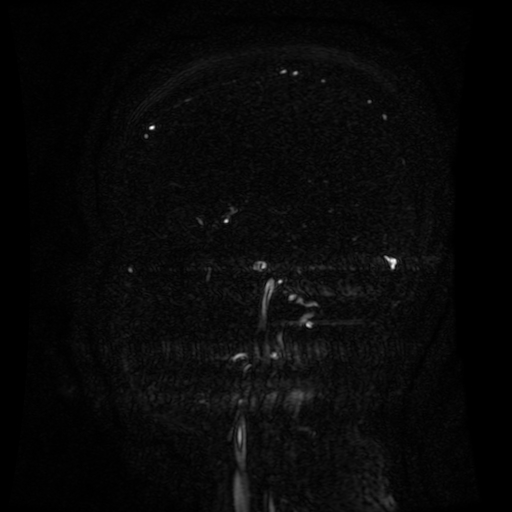 Normal noncontrast MR venography (Radiopaedia 87578-103957 A 115).jpg