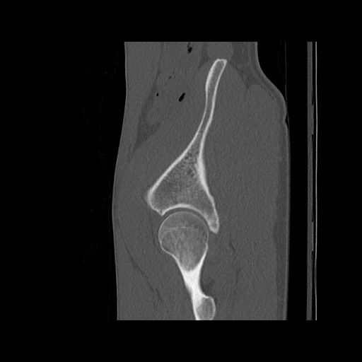 Normal pelvis (Radiopaedia 51473-57238 Sagittal bone window 119).jpg