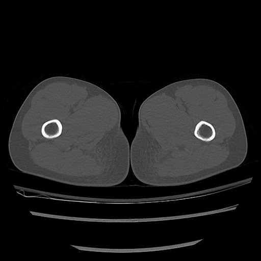 Normal pelvis CT (Radiopaedia 51471-57236 Axial bone window 110).jpg
