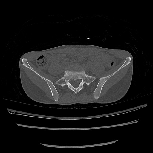 Normal pelvis CT (Radiopaedia 51471-57236 Axial bone window 21).jpg