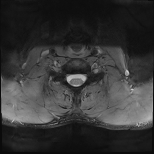 File:Normal trauma cervical spine (Radiopaedia 41017-43762 Axial T2 22).png