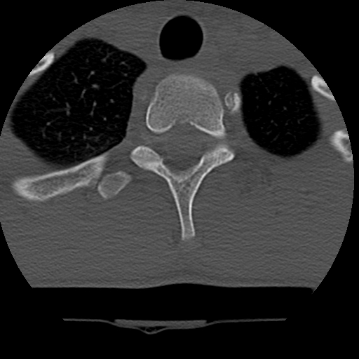 Normal trauma spine imaging (age 16) (Radiopaedia 45335-49358 Axial bone window 81).jpg