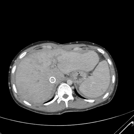 File:Nutmeg liver- Budd-Chiari syndrome (Radiopaedia 46234-50635 B 13).png