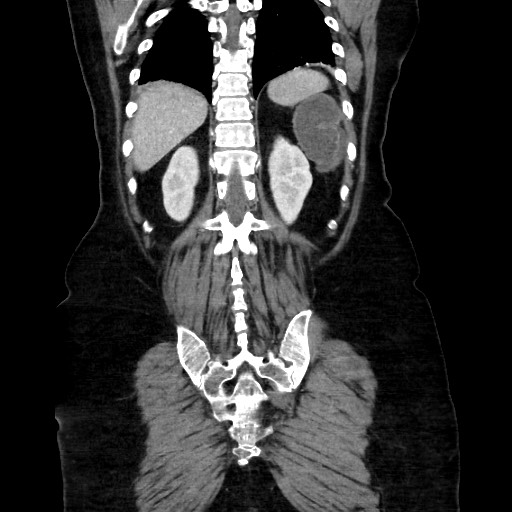Obstructive distal colonic adenocarcinoma causing cecal perforation (Radiopaedia 86830-102989 C 137).jpg