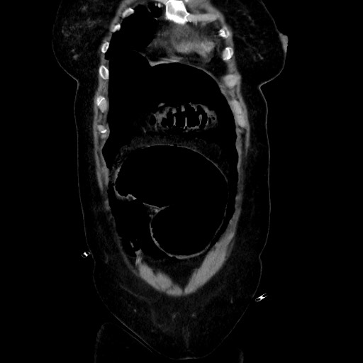 Obstructive distal colonic adenocarcinoma causing cecal perforation (Radiopaedia 86830-102989 C 54).jpg