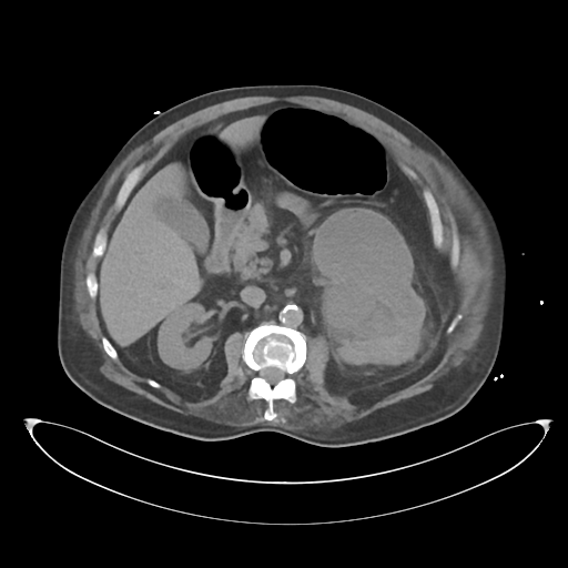 File:Obstructive pyelonephritis (Radiopaedia 46411-50844 Axial non-contrast 32).png