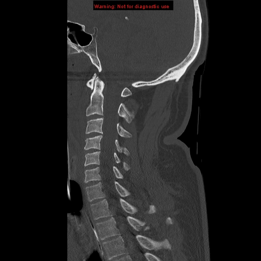 File:Occipital condyle fracture (Radiopaedia 18366-18208 Sagittal bone window 20).jpg