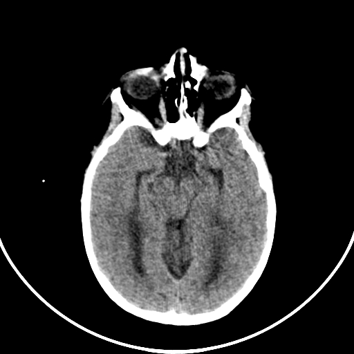 Occipital encephalocele (Radiopaedia 87339-103636 Axial non-contrast 34).jpg