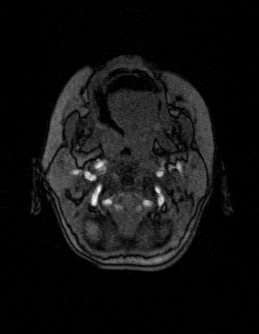 Occipital horn syndrome (Radiopaedia 14255-14129 MRA 8).jpg