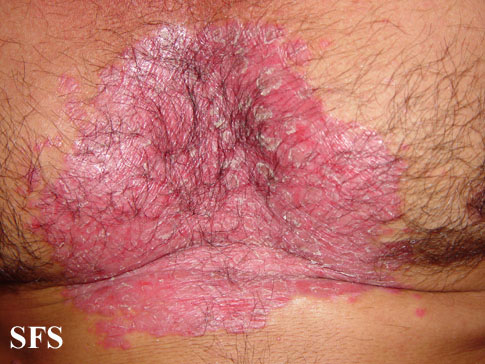 File:Psoriasis (Dermatology Atlas 24).jpg