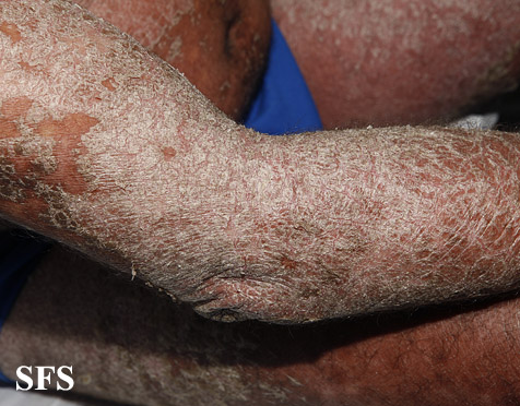 File:Psoriasis (Dermatology Atlas 60).jpg