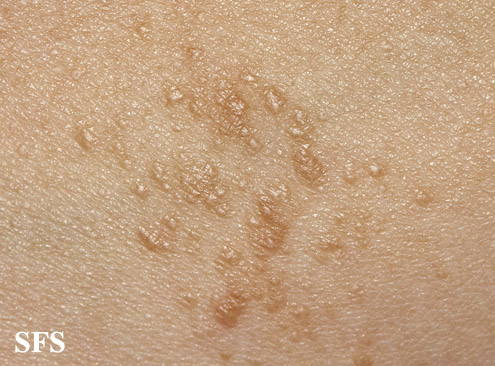 File:Syringoma (Dermatology Atlas 31).jpg