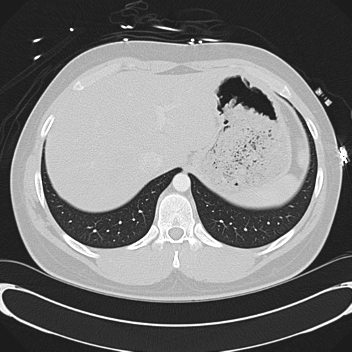 'Bovine' aortic arch (Radiopaedia 33554-34637 Axial lung window 56).png