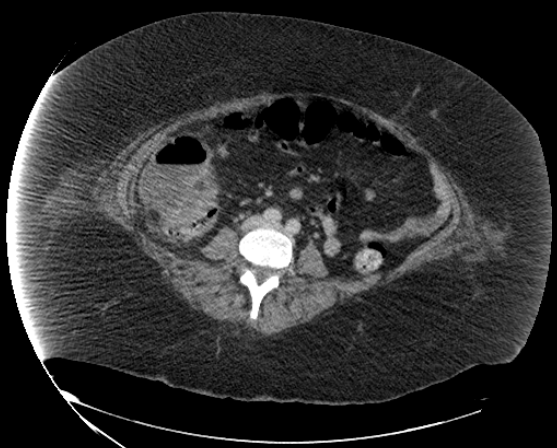 File:Abdominal abscess - pre and post percutaneous drainage (Radiopaedia 60209-67816 Axial 36).png