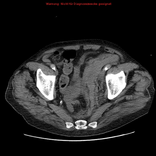 File:Abdominal aortic aneurysm- extremely large, ruptured (Radiopaedia 19882-19921 Axial C+ arterial phase 68).jpg