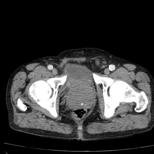 Abdominal aortic aneurysm (Radiopaedia 29248-29660 Axial C+ arterial phase 89).jpg
