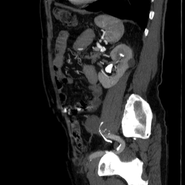 Abdominal aortic aneurysm (Radiopaedia 29248-29660 Sagittal C+ arterial phase 39).jpg