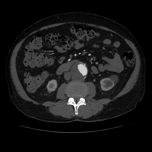 File:Abdominal aortic aneurysm (Radiopaedia 57318-64259 Axial C+ arterial phase 38).jpg