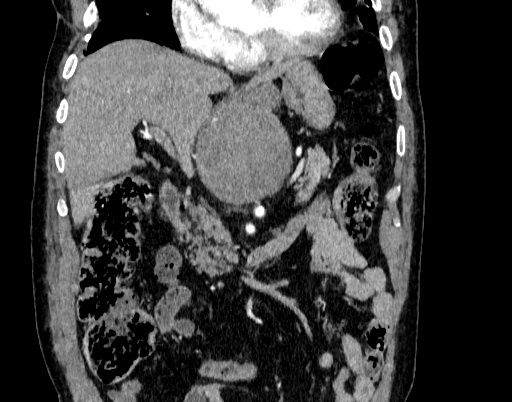 Abdominal aortic aneurysm (Radiopaedia 67117-76452 Coronal C+ arterial phase 29).jpg