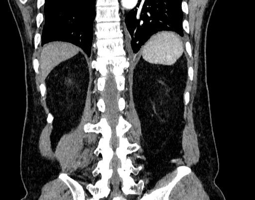 Abdominal aortic aneurysm (Radiopaedia 67117-76452 Coronal C+ arterial phase 86).jpg