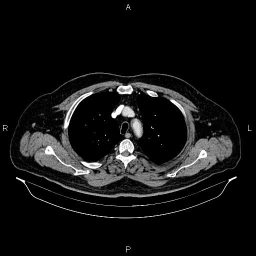 Abdominal aortic aneurysm (Radiopaedia 83094-97462 Axial renal cortical phase 20).jpg
