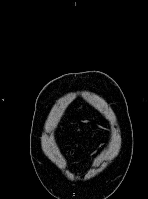Abdominal aortic aneurysm (Radiopaedia 83094-97462 Coronal renal cortical phase 5).jpg
