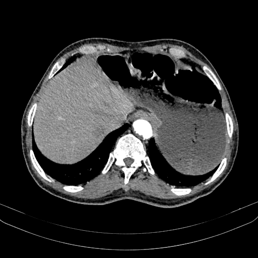 Abdominal aortic aneurysm (Radiopaedia 83581-98689 Axial C+ arterial phase 22).jpg