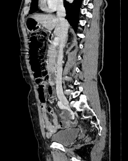 Abdominal aortic aneurysm (Radiopaedia 83581-98689 Sagittal C+ portal venous phase 29).jpg