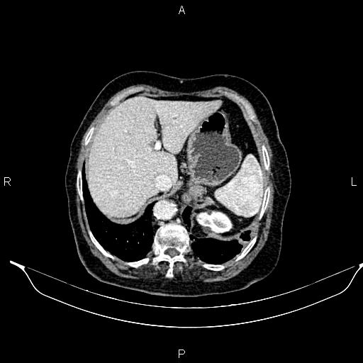 File:Abdominal aortic aneurysm (Radiopaedia 85063-100606 Axial C+ portal venous phase 30).jpg
