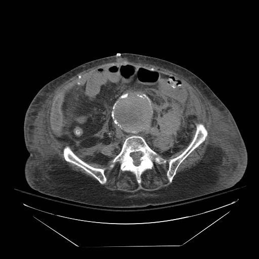 Abdominal aortic aneurysm - impending rupture (Radiopaedia 19233-19247 Axial non-contrast 110).jpg
