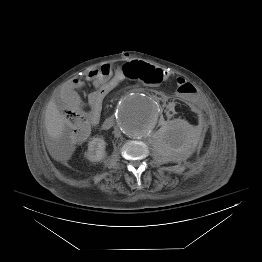 Abdominal aortic aneurysm - impending rupture (Radiopaedia 19233-19247 Axial non-contrast 91).jpg