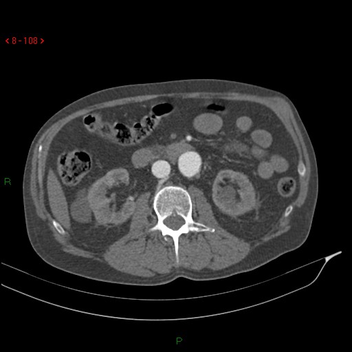 Abdominal aortic aneurysm rupture with aortocaval fistula (Radiopaedia 14897-14841 Axial C+ arterial phase 108).jpg