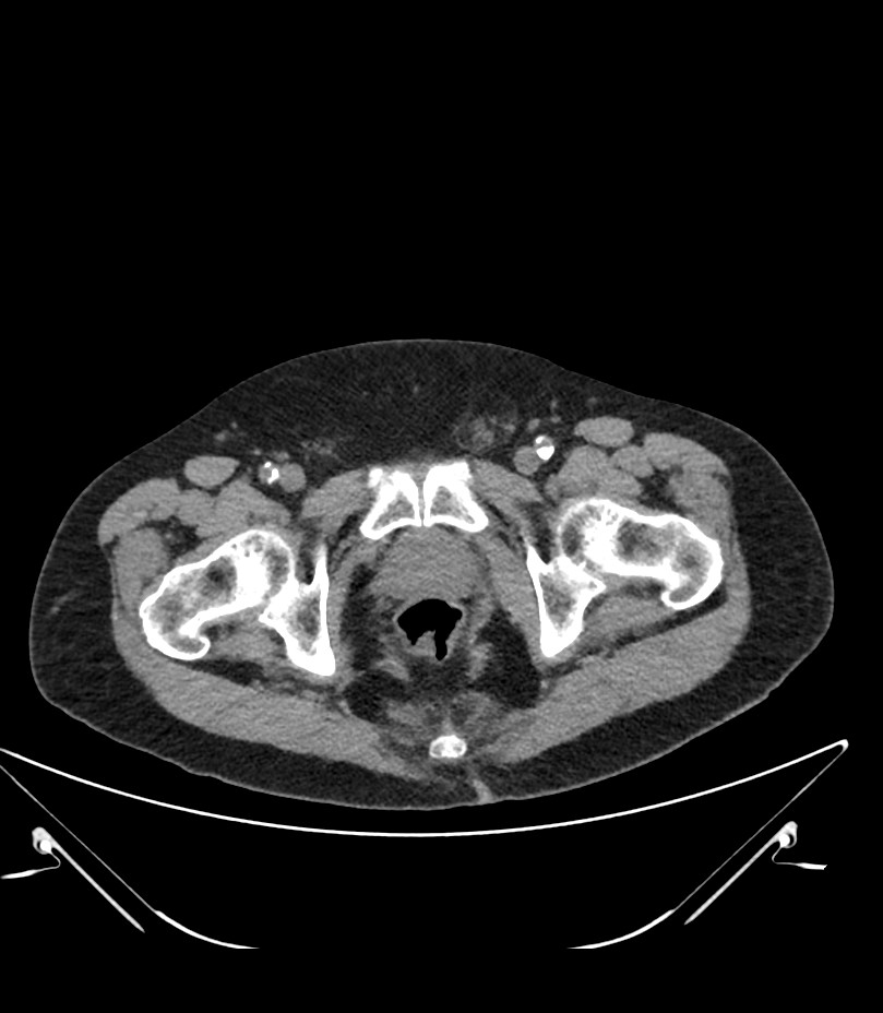 Abdominal aortic aneurysm with thrombus fissuration (Radiopaedia 46218-50618 Axial non-contrast 58).jpg