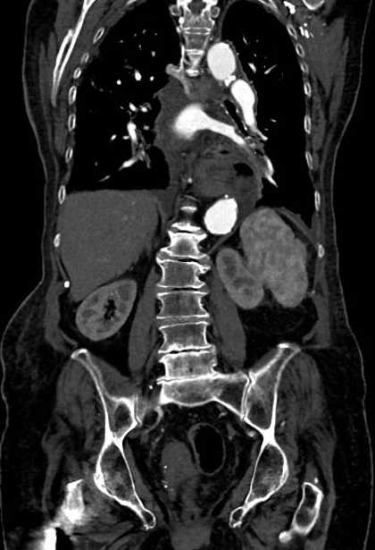 Abdominal aortic aneurysm with thrombus fissuration (Radiopaedia 73192-83919 Coronal C+ arterial phase 57).jpg