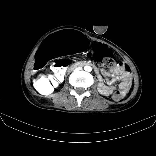 File:Abdominal collection due to previous cecal perforation (Radiopaedia 80831-94320 Axial C+ portal venous phase 106).jpg