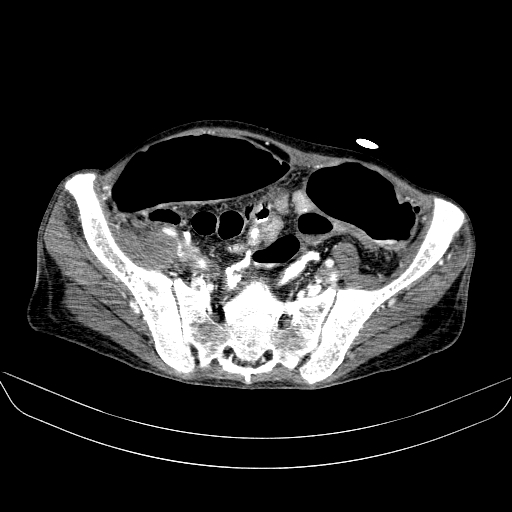 File:Abdominal collection due to previous cecal perforation (Radiopaedia 80831-94320 Axial C+ portal venous phase 160).jpg