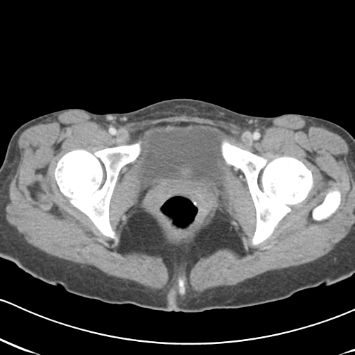 Abdominal desmoid tumor (Radiopaedia 41007-43740 Axial C+ portal venous phase 70).png
