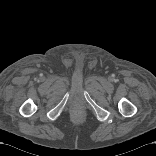 Abdominal hematoma (Radiopaedia 33614-34715 Axial C+ portal venous phase 145).png