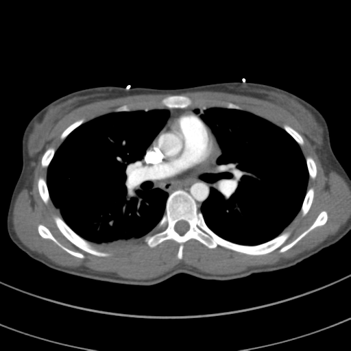 File:Abdominal multi-trauma - devascularised kidney and liver, spleen and pancreatic lacerations (Radiopaedia 34984-36486 Axial C+ arterial phase 39).png