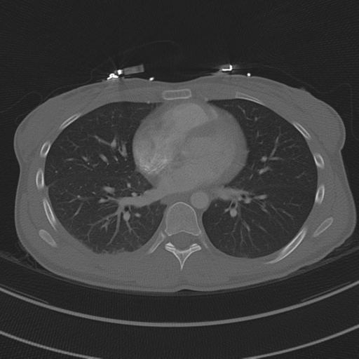 File:Abdominal multi-trauma - devascularised kidney and liver, spleen and pancreatic lacerations (Radiopaedia 34984-36486 I 51).png