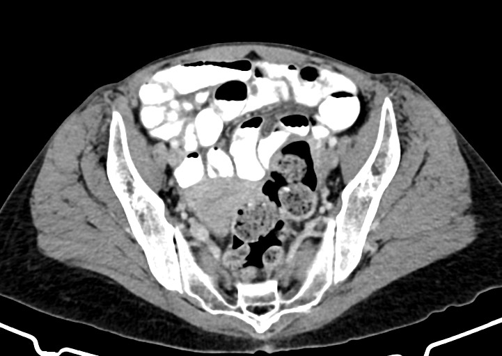 Abdominal wall and retroperitoneal tuberculosis (Radiopaedia 88137-104729 Axial C+ portal venous phase 154).jpg