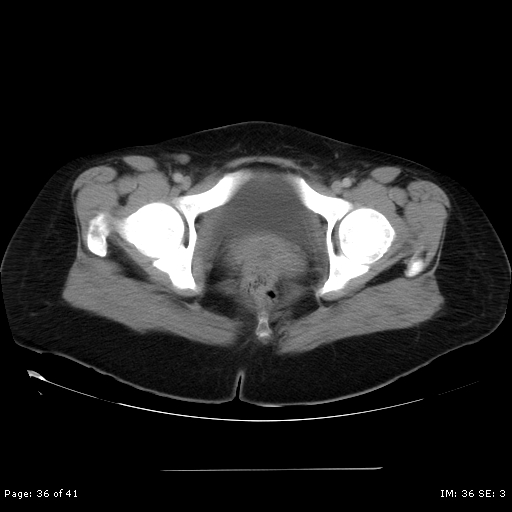 File:Abdominal wall endometriosis (Radiopaedia 25723-25885 Axial C+ portal venous phase 36).jpg