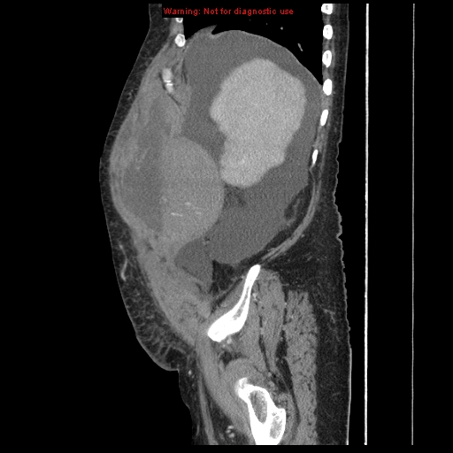 Abdominal wall hematoma (Radiopaedia 9427-10112 Sagittal C+ portal venous phase 87).jpg