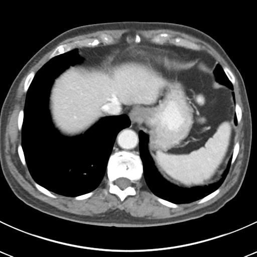 File:Abdominal wall metastasis from colorectal carcinoma (Radiopaedia 31016-31717 Axial C+ portal venous phase 13).jpg