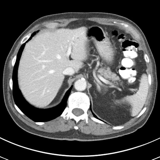 Abdominal wall metastasis from colorectal carcinoma (Radiopaedia 31016-31717 Axial C+ portal venous phase 18).jpg