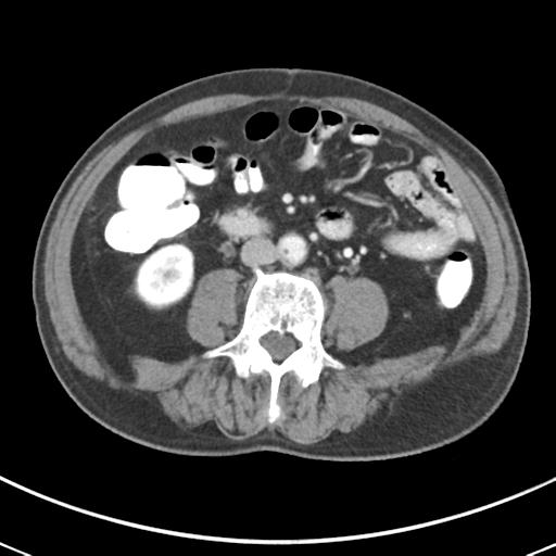 Abdominal wall metastasis from colorectal carcinoma (Radiopaedia 31016-31717 Axial C+ portal venous phase 42).jpg