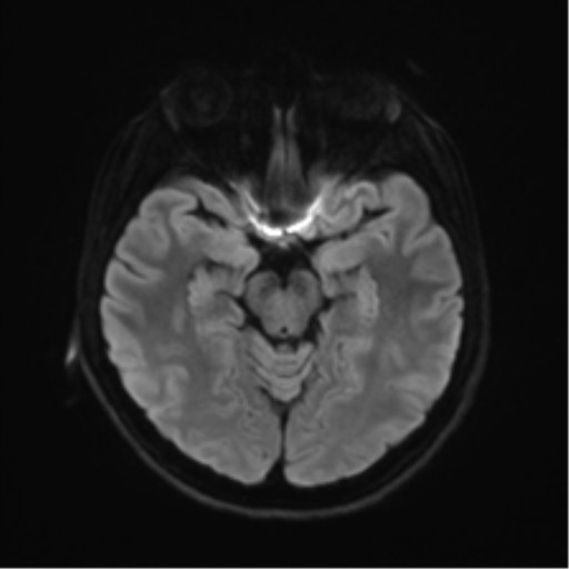 Abducens nerve palsy (Radiopaedia 51069-56648 Axial DWI 37).png