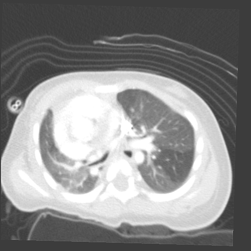 File:Aberrant left pulmonary artery (pulmonary sling) (Radiopaedia 42323-45435 Axial lung window 17).jpg