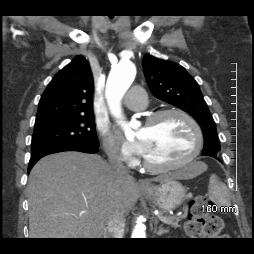 Aberrant right subclavian artery stenosis (Radiopaedia 52656-58670 B 40).jpg