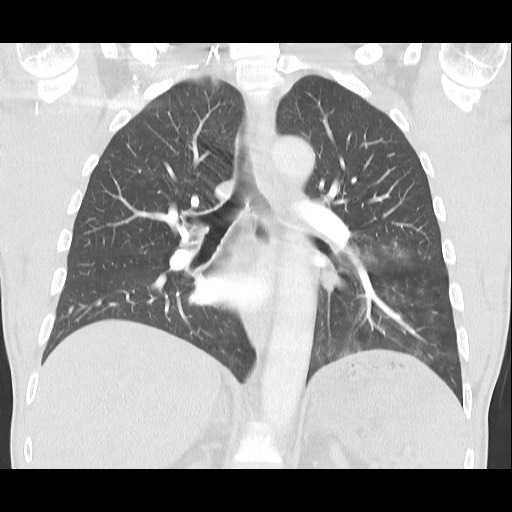 Accessory left horizontal fissure with lingular pneumonia (Radiopaedia 53763-59843 Coronal lung window 27).jpg